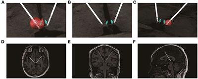 Case Report: Lateral Habenula Deep Brain Stimulation for Treatment-Resistant Depression